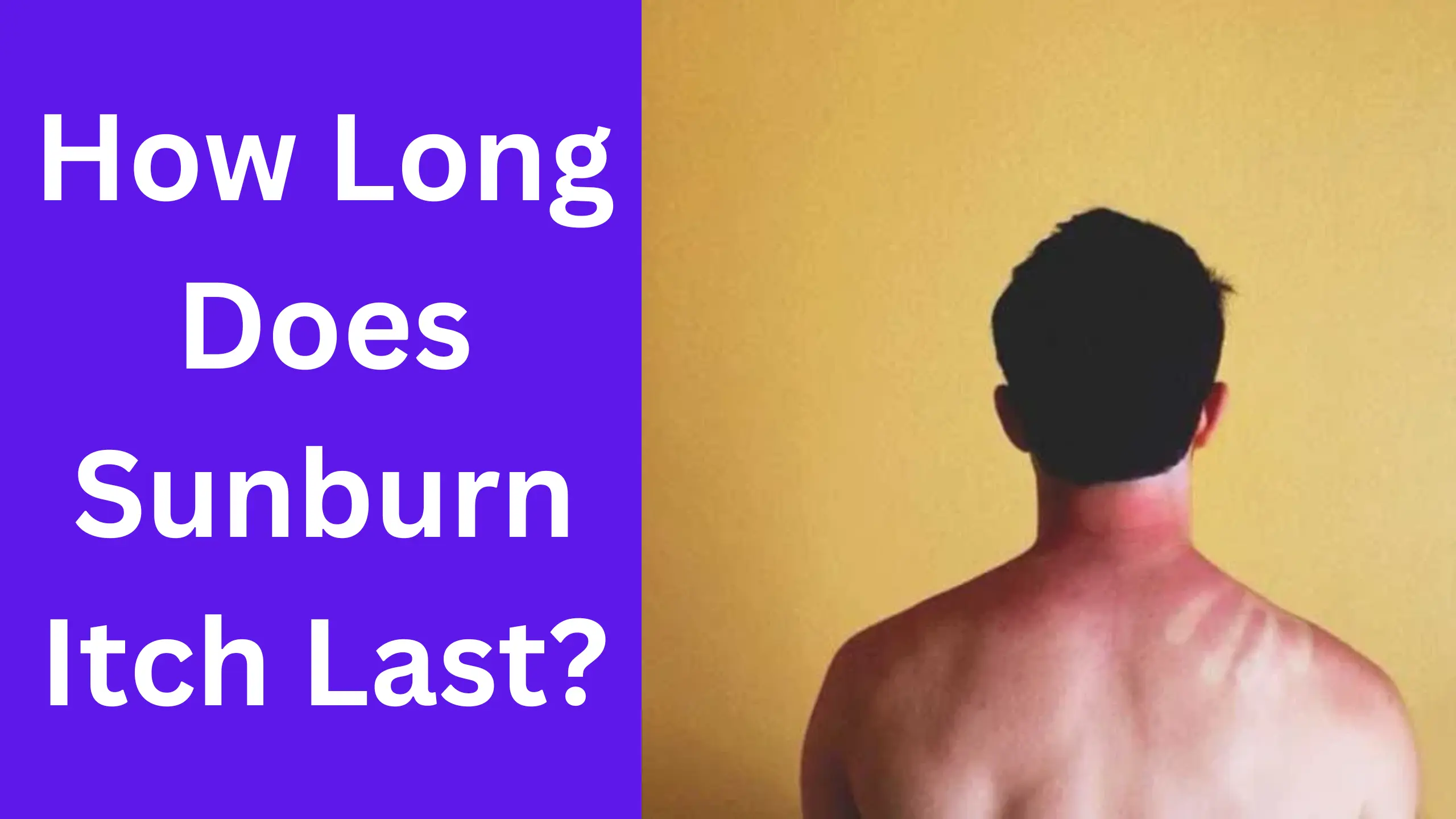 How Long Does Sunburn Itch Last?